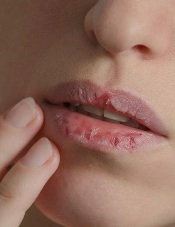 دلایل ایجاد ترک لب‌ها